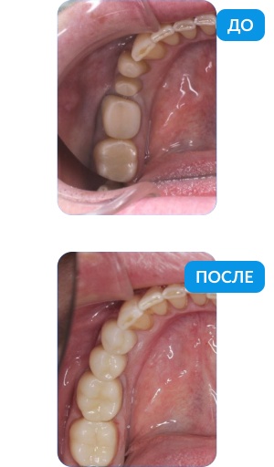 Эстетическая улыбка за 2 недели