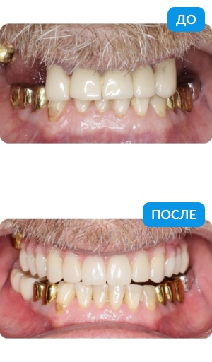 25% зубного ряда за полнедели